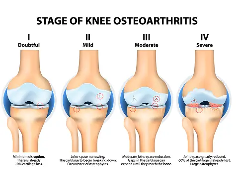Medical diagram illustrating the four stages of knee osteoarthritis — from doubtful to mild, moderate, and severe — showing progressive cartilage breakdown and joint deterioration, as treated at California Joint Pain Institute in Irvine, CA.